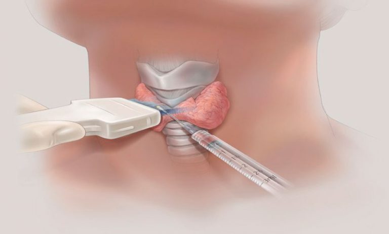PAAF de Tireoide Guiada por Ultrassonografia